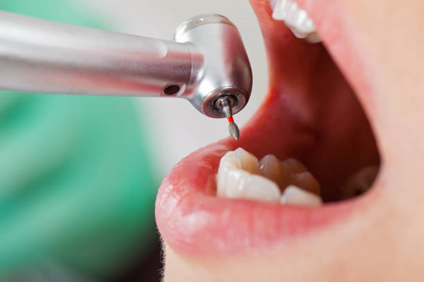 Best Lost Filling or Crown Replacement in Oconto Falls, WI